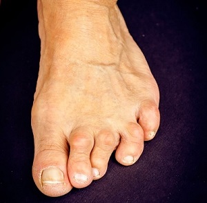 törések kezelése a lábujjak diabéteszben