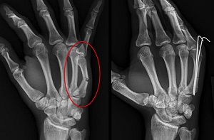 miért fáj a bal kéz gyűrűujja ízülete fájdalom a jobb hüvelykujjízületében