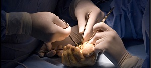 kézsebészet - pattanóujj műtét