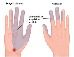 a jobb kéz középső ujjának zsibbadása izületi gyulladás