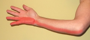 a hüvelykujj ízülete carpal arthritis kezelése