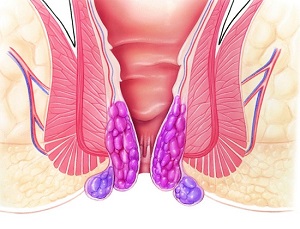 A fekélyes vastagbélgyulladás (colitis ulcerosa)