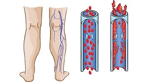 Amit a mélyvénás trombózisról tudni érdemes - Hogyan kezeljük az alsó lábszár vörös foltjait