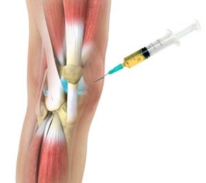 Artrózis kezelés milyen injekciók - Három hatékony injekciós kezelés porckopásnál