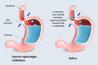fogyás gyógyítja a refluxot fogyás egyenetlen mellméret
