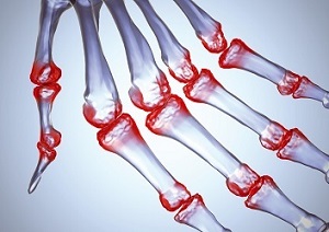 áttekintés a boka osteoarthritis kezeléséről