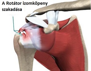 rotator köpeny szindróma bno boka ízületi arthrosis kezelése