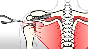 rotátor köpeny szindróma tünetei fájdalom a kar ízületében egy kötszerrel