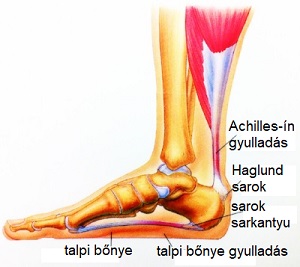 artritisz artrózis mágneses kezelés krónikus boka ligamentum károsodás