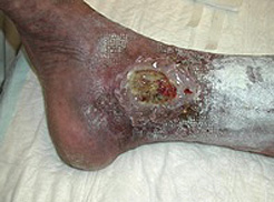 Cukorbeteg lábon, a nyomáspontok helyén kialakult nem gyógyuló sebek kezelése