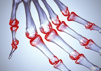ízületek ugrás után ugrálókötél rheumatoid arthrosis mint a kezelés
