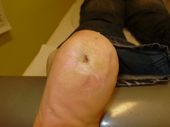 A láb lábának pirossága okozza - Allergének November