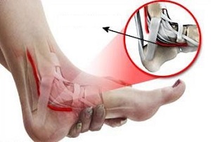 Lábujj zsibbadás kezelése lábfeje tornáztatásával - Középső lábujj zsibbadása