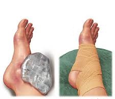 Nagy lábujj ízületi fájdalom törés után, Hogyan sérülhetnek meg a lábközépcsontok?