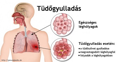 tüdőgyulladás cukorbetegség és a kezelés