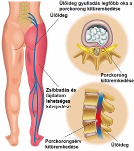 Csípőből lábba sugárzó fájdalom kezelése