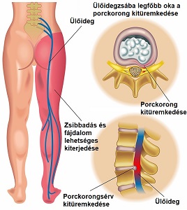 A csípőízület kopása - Okok és tünetek, Csípő forgó fájdalom
