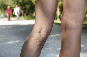 Miért csökkenti a lábak vénáit és hogyan kell kezelni a visszeres görcsöket